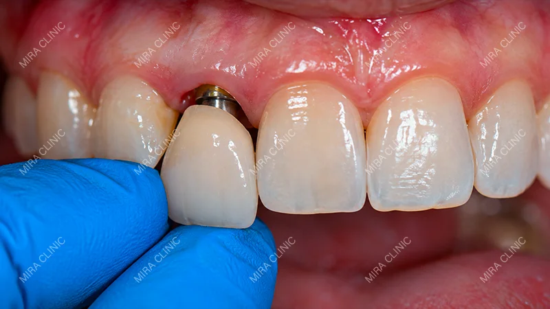Loose implant